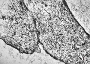 F,80y. | leiomyosarcoma - thigh F,80y. | leiomyosarcoma - thigh